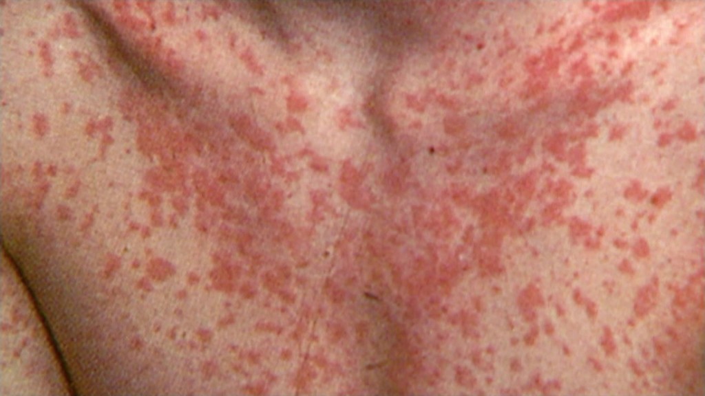Masernerkrankung - die Haut eines Jugentlichen ist mit einem für Masern typischen roten Auschlag bedeckt