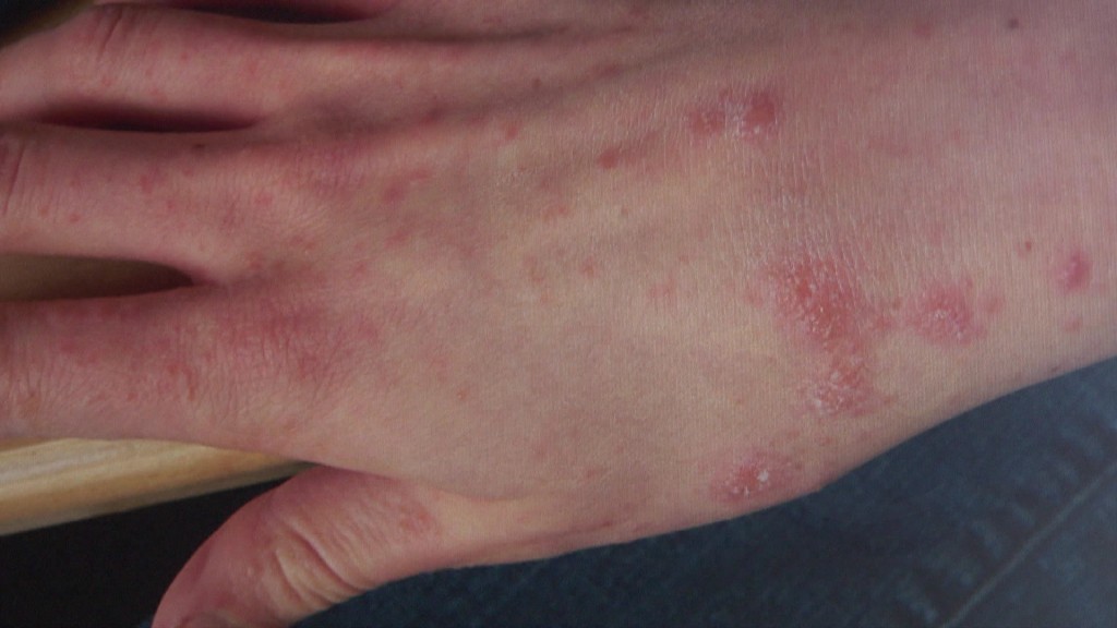 Foto: Die Hand einer mit Krätzmilbe erkrankten Person