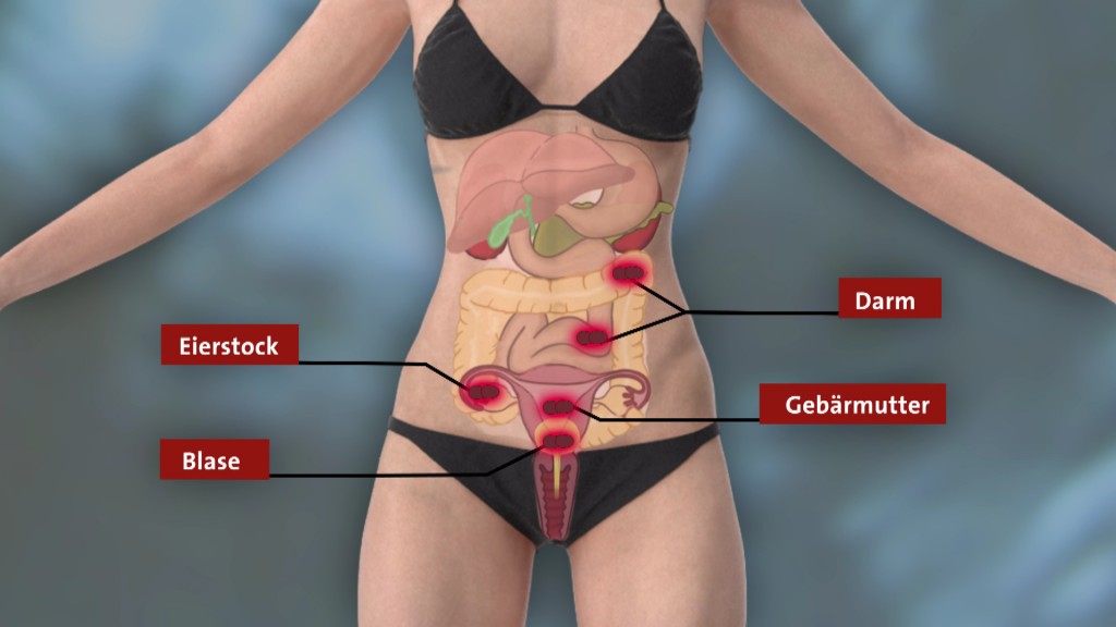 Foto: Grafik von weiblichen Unterleibsorganen zum Thema Endometriose