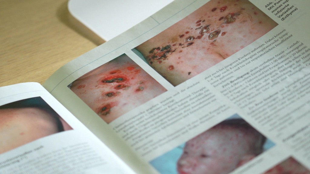 Windpocken-Abbildungen in einem Buch 