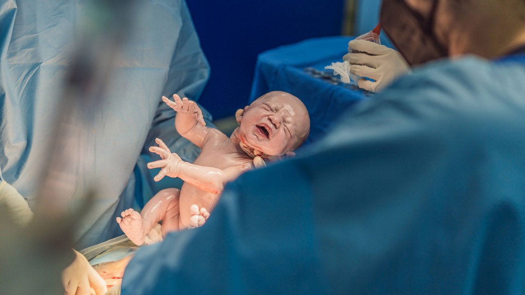 Ein Baby wird per Kaiserschnitt entbunden.