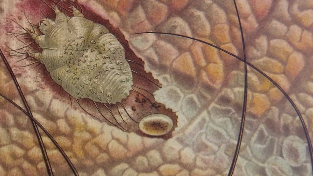 Foto: Mikroskopische Aufnahme einer Krätze-Milbe