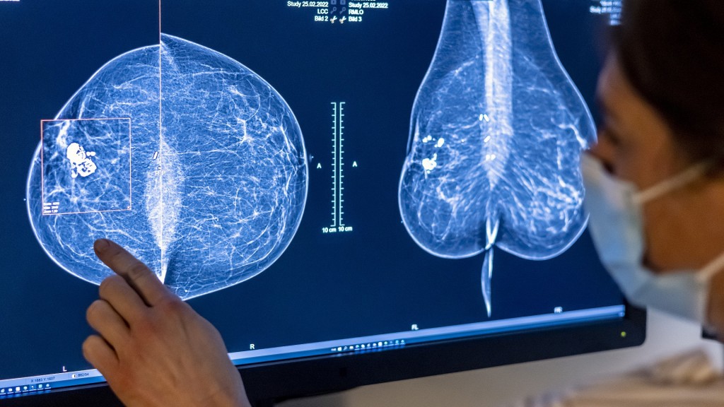 Foto: Medizinisches Personal untersucht mit einer Mammografie die Brust einer Frau auf Brustkrebs.